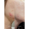 Acnemy POSTZIT Corrector Serum 30 ml - 2