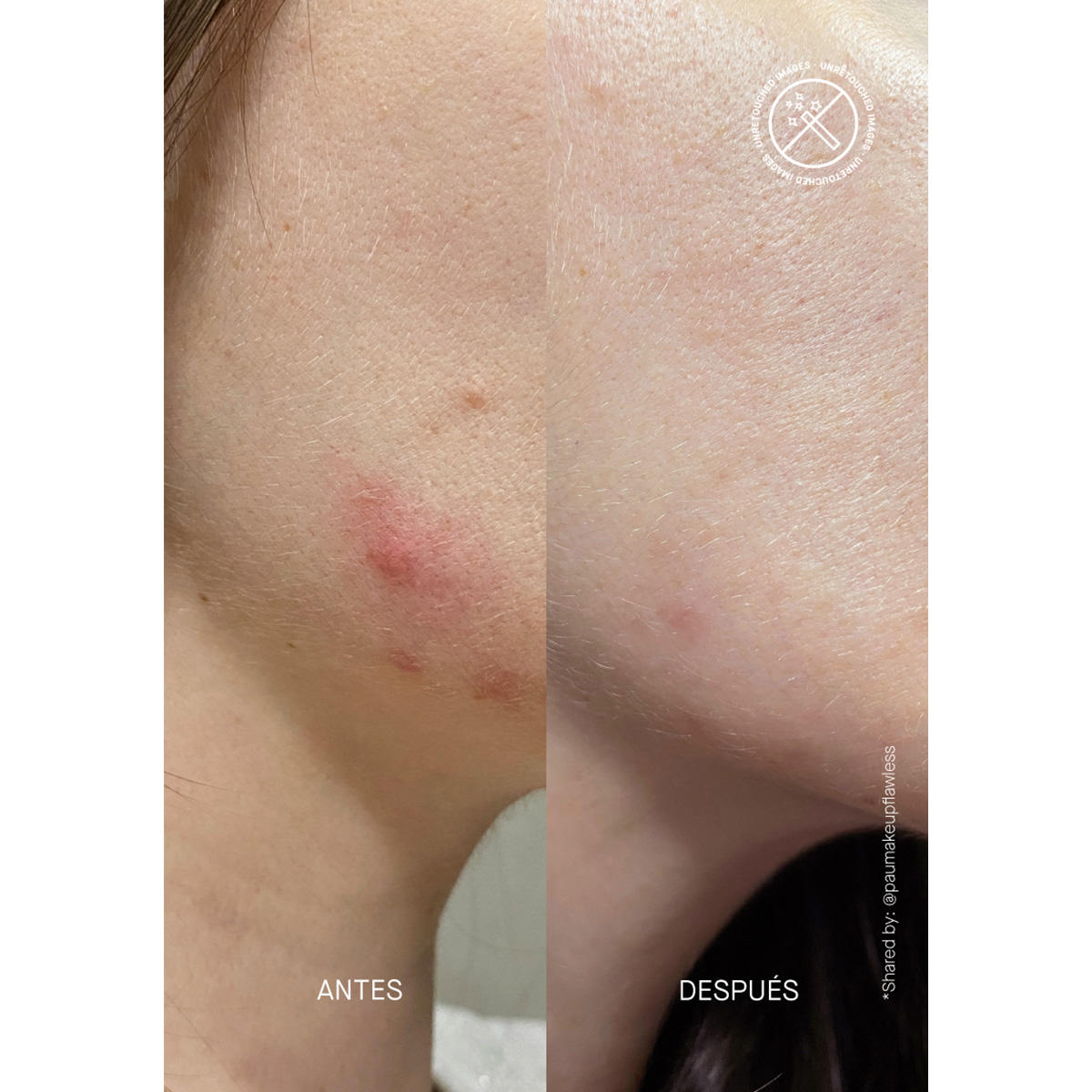Acnemy POSTZIT Corrector Serum 30 ml - 2