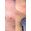 Acnemy ZITCONTROL Blemish Control Moisturizer 40 ml - 4